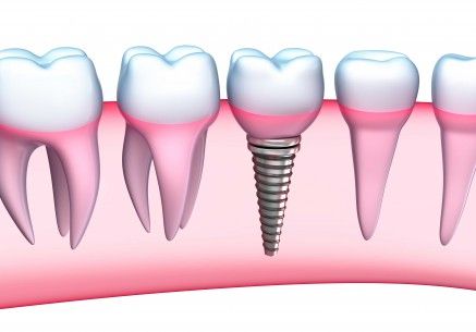 implant_2-437×305-large